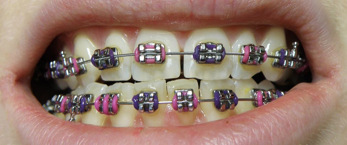 Teeth with metal braces and coloured elastic ties on the upper and lower arches